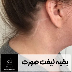 بخیه لیفت صورت - دکتر امین قانعی 