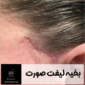 بخیه لیفت صورت - دکتر امین قانعی 