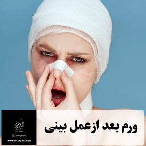 ورم بعد از عمل بینی