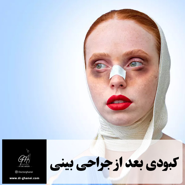 کبودی بعد از جراحی بینی