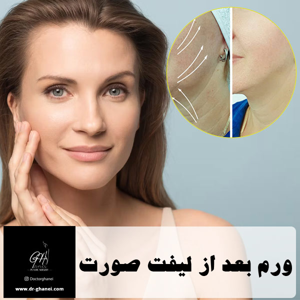 ورم بعد از لیفت صورت