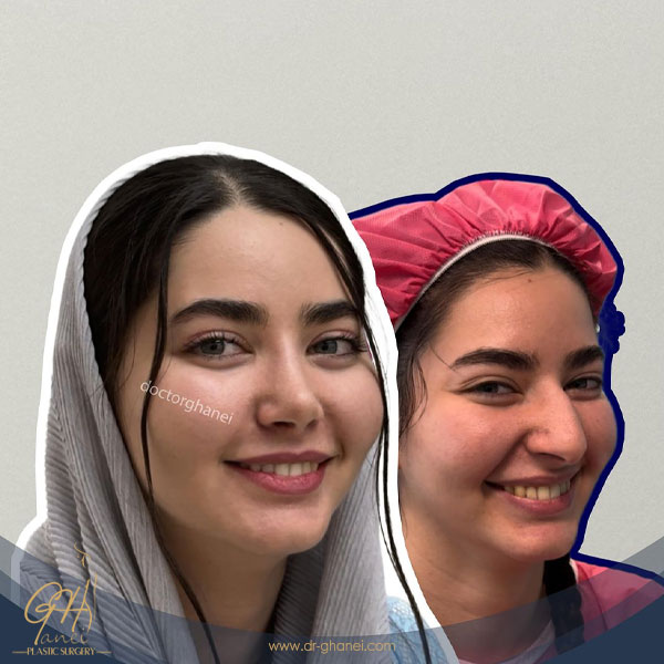 نمونه کار بهترین جراح بینی طبیعی اصفهان