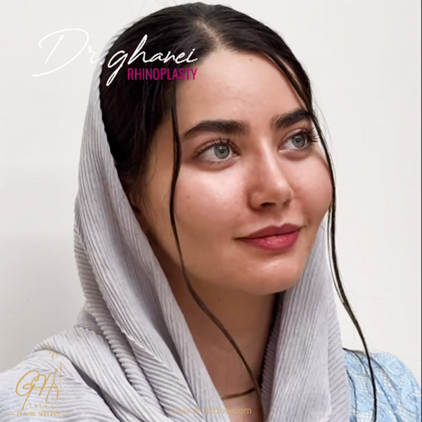 نمونه کار بهترین جراح بینی طبیعی اصفهان