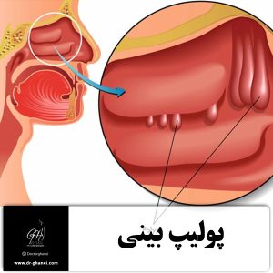 پولیپ بینی