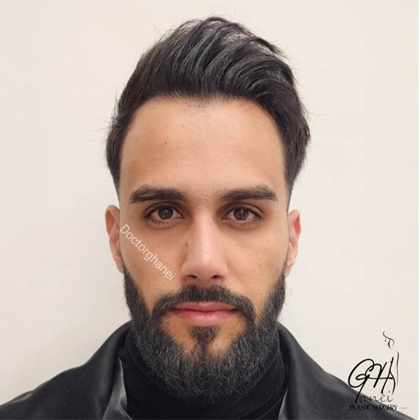 جراحی بینی طبیعی