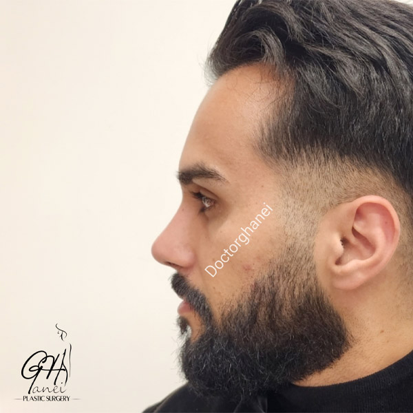 جراحی بینی طبیعی