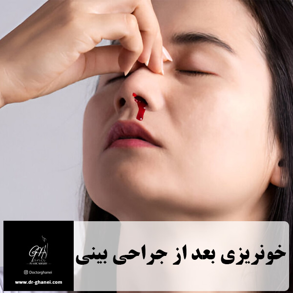 خونریزی بعد از جراحی بینی