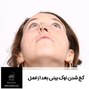 کج شدن بینی بعد از عمل