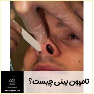 تامپون بینی - دکتر امین قانعی
