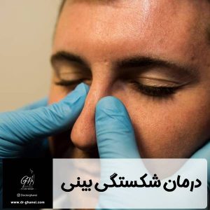 شکستگی بینی - دکتر قانعی