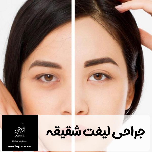 جراحی لیفت شقیقه - دکتر امین قانعی