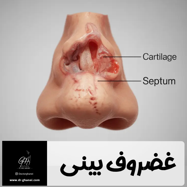 غضروف بینی - دکتر قانعی