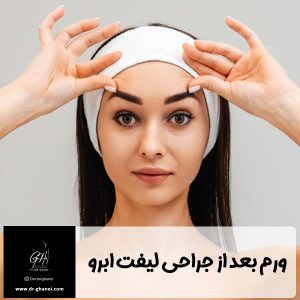 ورم بعد از جراحی لیفت ابرو - دکتر امین قانعی