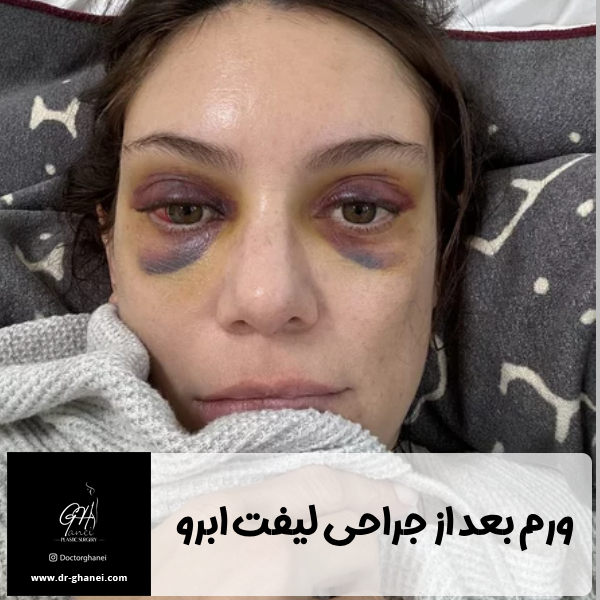 ورم بعد از لیفت ابرو - دکتر امین قانعی 