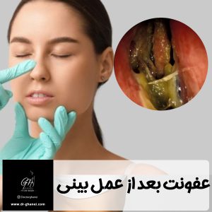 عفونت بینی بعد از عمل - دکتر امین قانعی
