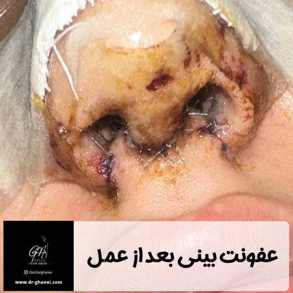 عفونت بینی بعد از عمل  - دکتر امین قانعی