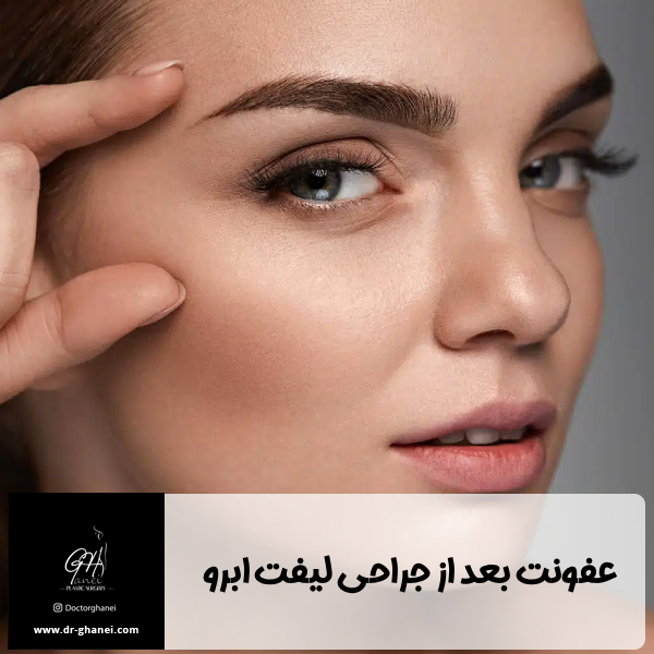 عفونت بعد از جراحی لیفت ابرو - دکتر قانعی