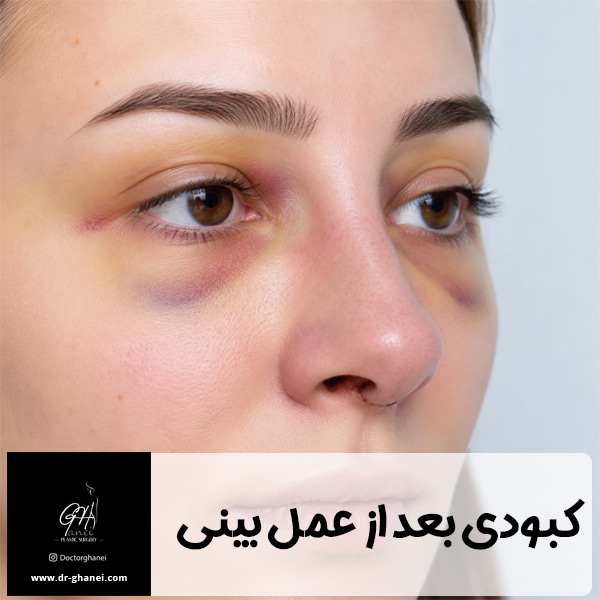 کبودی بعد از عمل بینی - دکتر قانعی