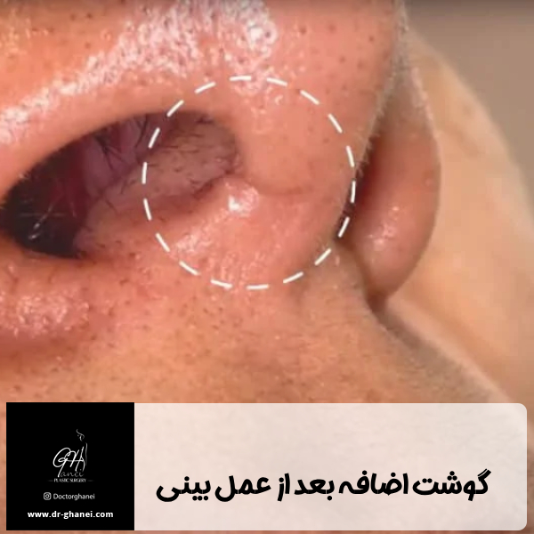 گوشت اضافه بعد از عمل بینی - دکتر امین قانعی 