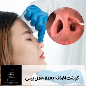 گوشت اضافه بعد از عمل بینی - دکتر امین قانعی