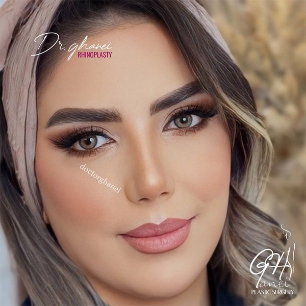 جراحی بینی طبیعی - دکتر امین قانعی