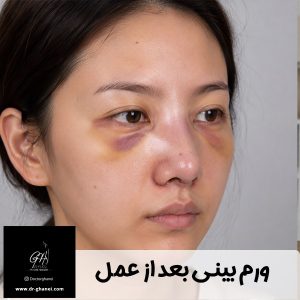ورم بینی بعد از عمل - دکتر قانعی