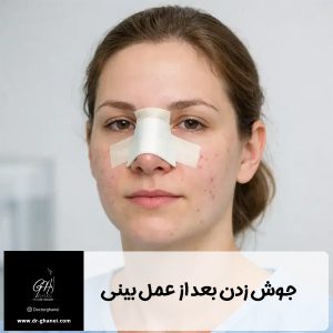 جوش زدن بعد از عمل بینی - دکتر امین قانعی