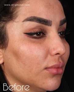 عکس بینی عمل شده اصفهان 