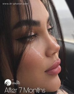 عکس بینی عمل شده اصفهان 