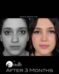 عکس عمل بینی اصفهان 